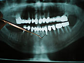 R�ntgenbild eines Gebisses