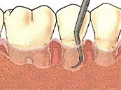 Parodontitis-K&uuml;rettage